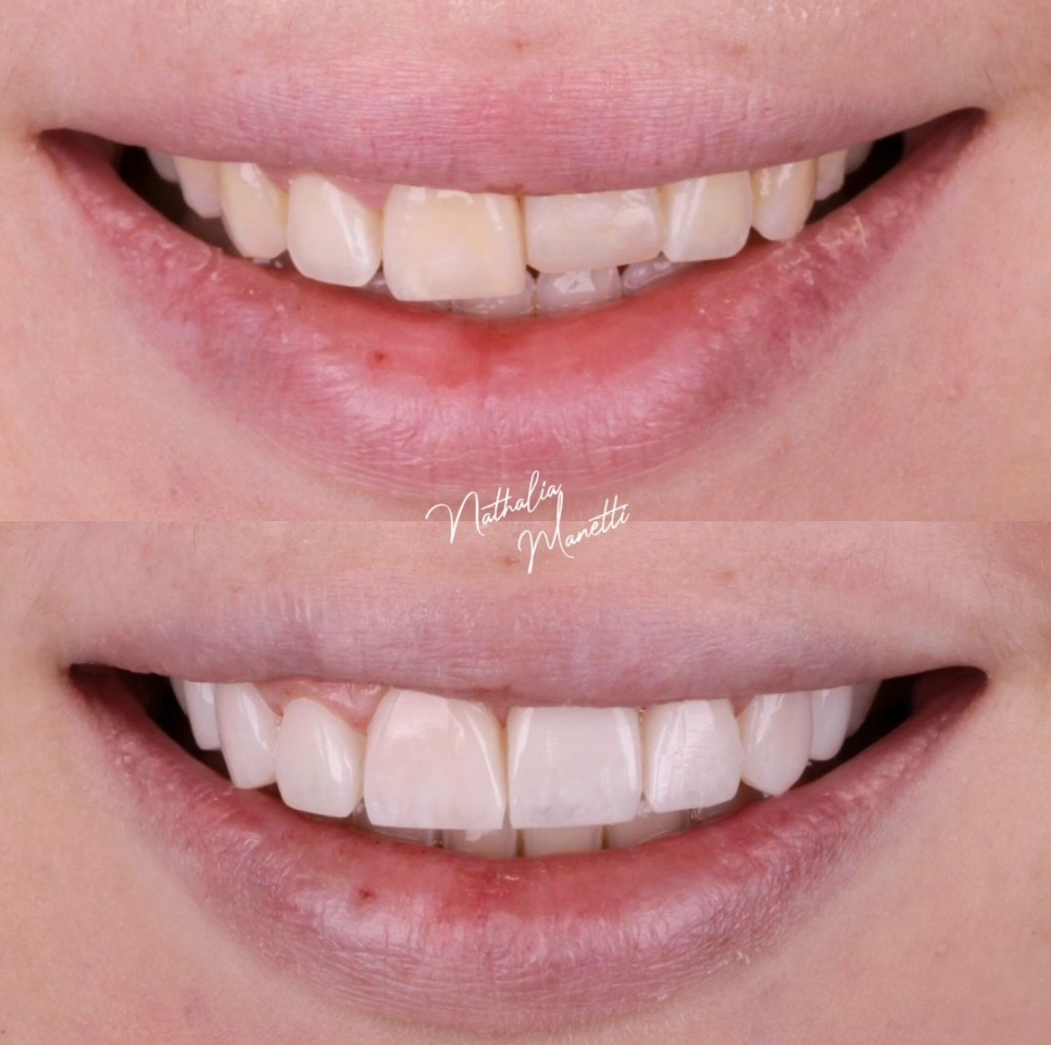 Caso real: Correção de diastema e alinhamento dental - Dra. Nathalia Manetti